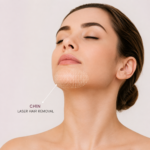 Chin Laser Hair Removal