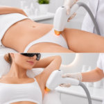 Hollywood + Underarms Laser Hair Removal Package - Image 2
