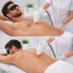Men’s Chest + Back Laser Hair Removal - Image 2